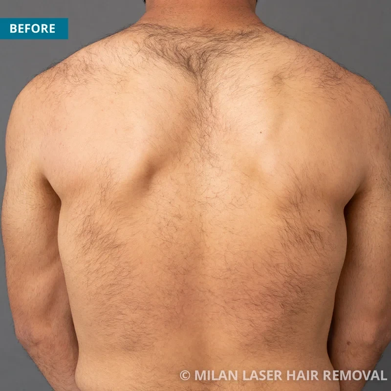 Men s Before After Photos of Laser Hair Removal Milan Laser in